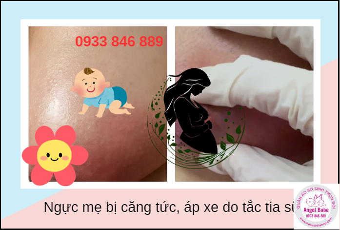 hiện tượng căng tức ngực mẹ do tắc tia sữa