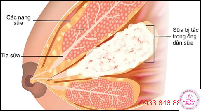 tắc tia sữa ở mẹ sau sinh là gì